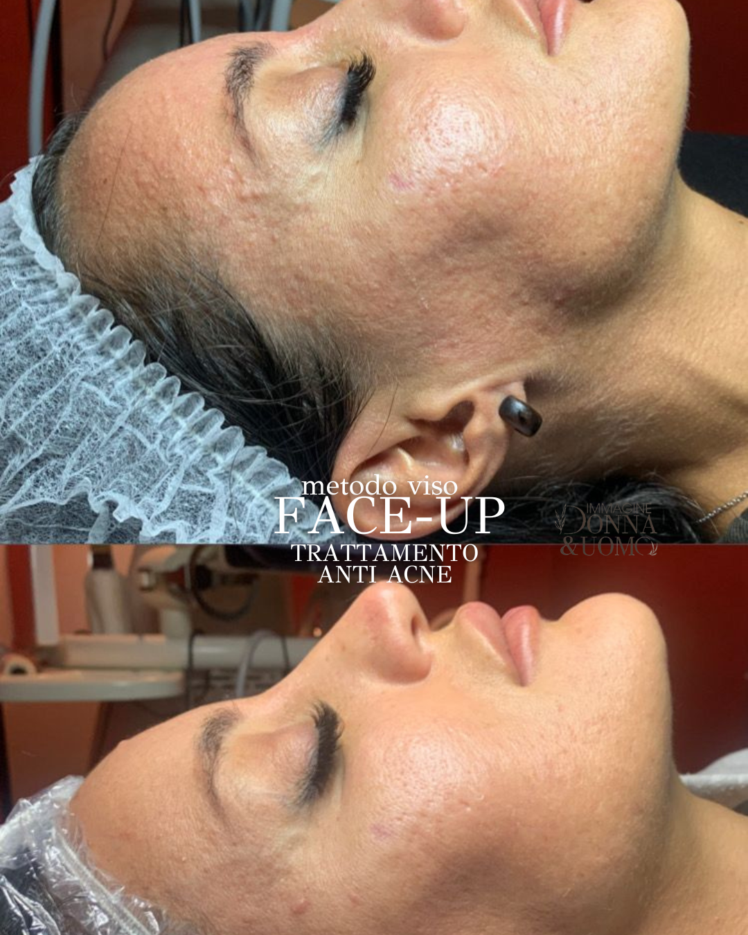 Negli ultimi anni, sempre più donne e uomini cercano soluzioni anti-age non invasive che garantiscano&nbsp;risultati visibili senza tempi di recupero lunghi né rischi legati alla chirurgia estetica.